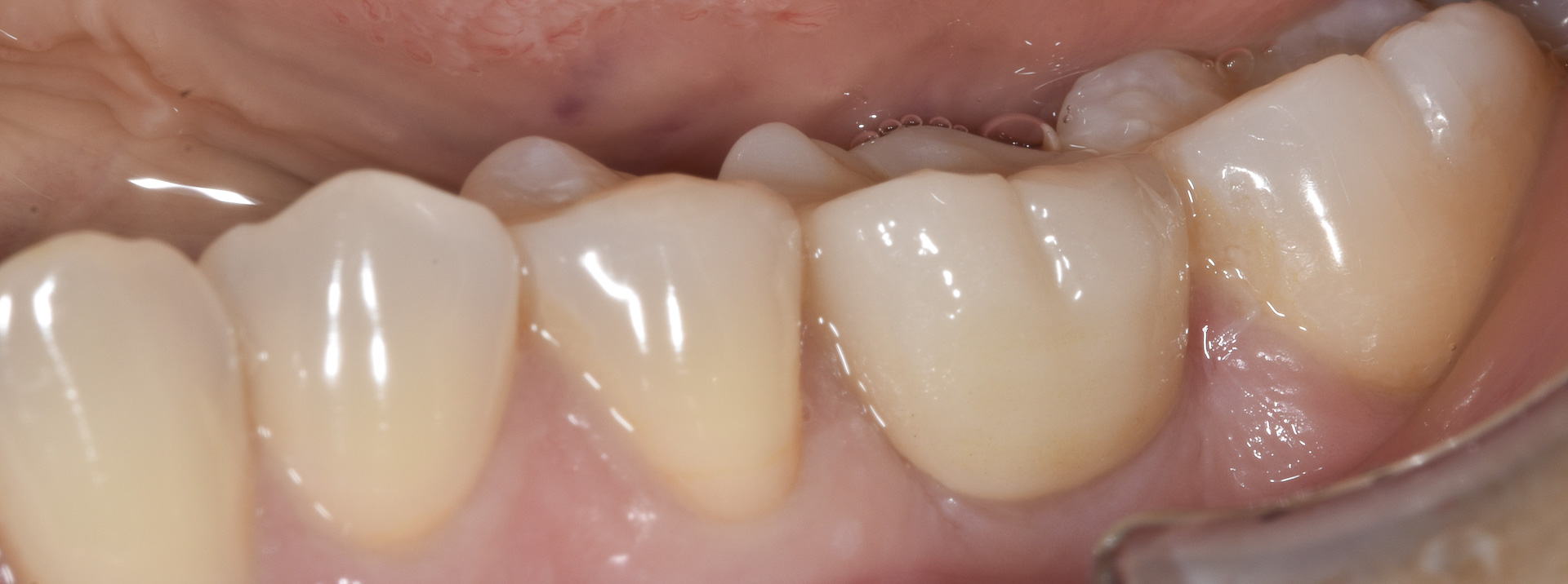 quarta-odontoiatria-studio-dentistico-carmiano-provincia-di-lecce-casi-clinici73implantologia-quarta-odontoiatria-studio-dentistico-carmiano-lecce