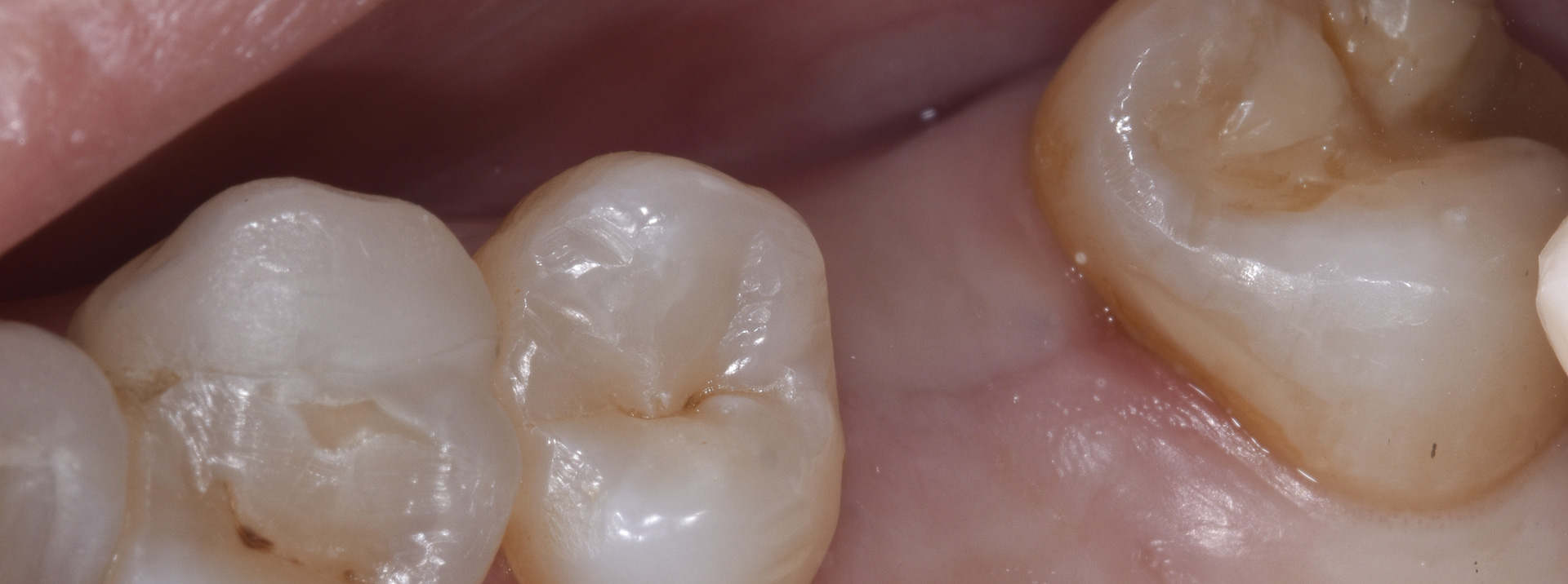 quarta-odontoiatria-studio-dentistico-carmiano-provincia-di-lecce-casi-clinici74implantologia-quarta-odontoiatria-studio-dentistico-carmiano-lecce