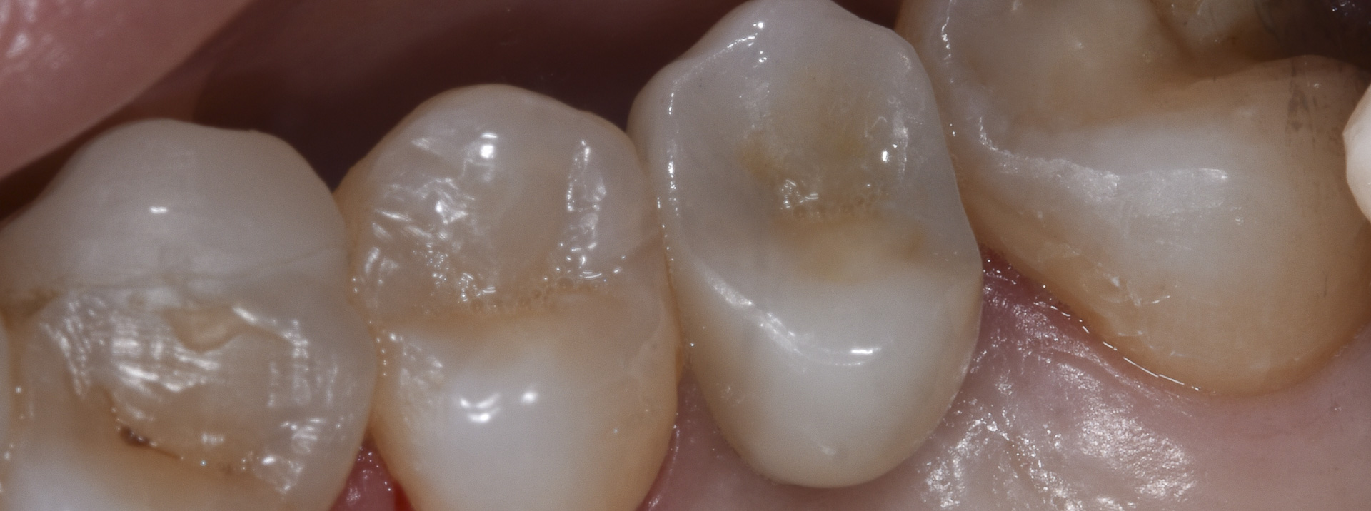 quarta-odontoiatria-studio-dentistico-carmiano-provincia-di-lecce-casi-clinici75implantologia-quarta-odontoiatria-studio-dentistico-carmiano-lecce