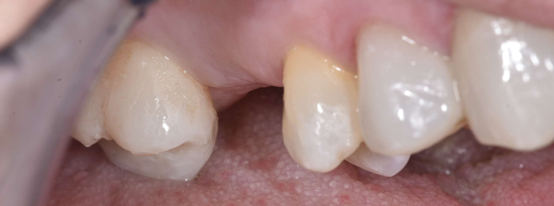 quarta-odontoiatria-studio-dentistico-carmiano-provincia-di-lecce-casi-clinici76implantologia-quarta-odontoiatria-studio-dentistico-carmiano-lecce