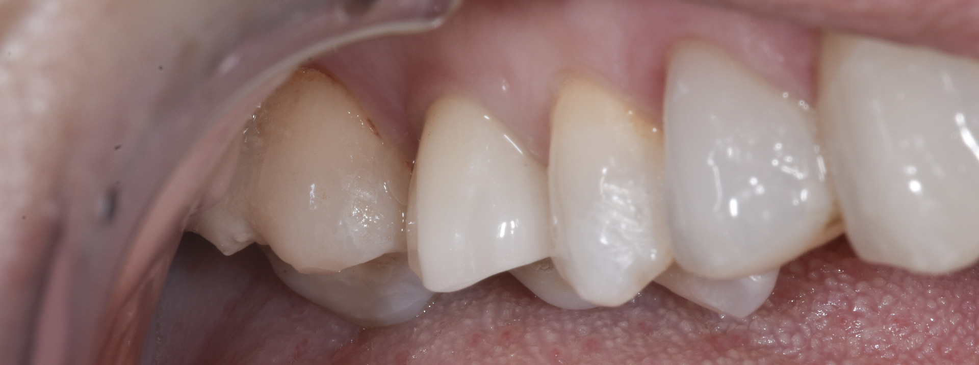 quarta-odontoiatria-studio-dentistico-carmiano-provincia-di-lecce-casi-clinici77implantologia-quarta-odontoiatria-studio-dentistico-carmiano-lecce