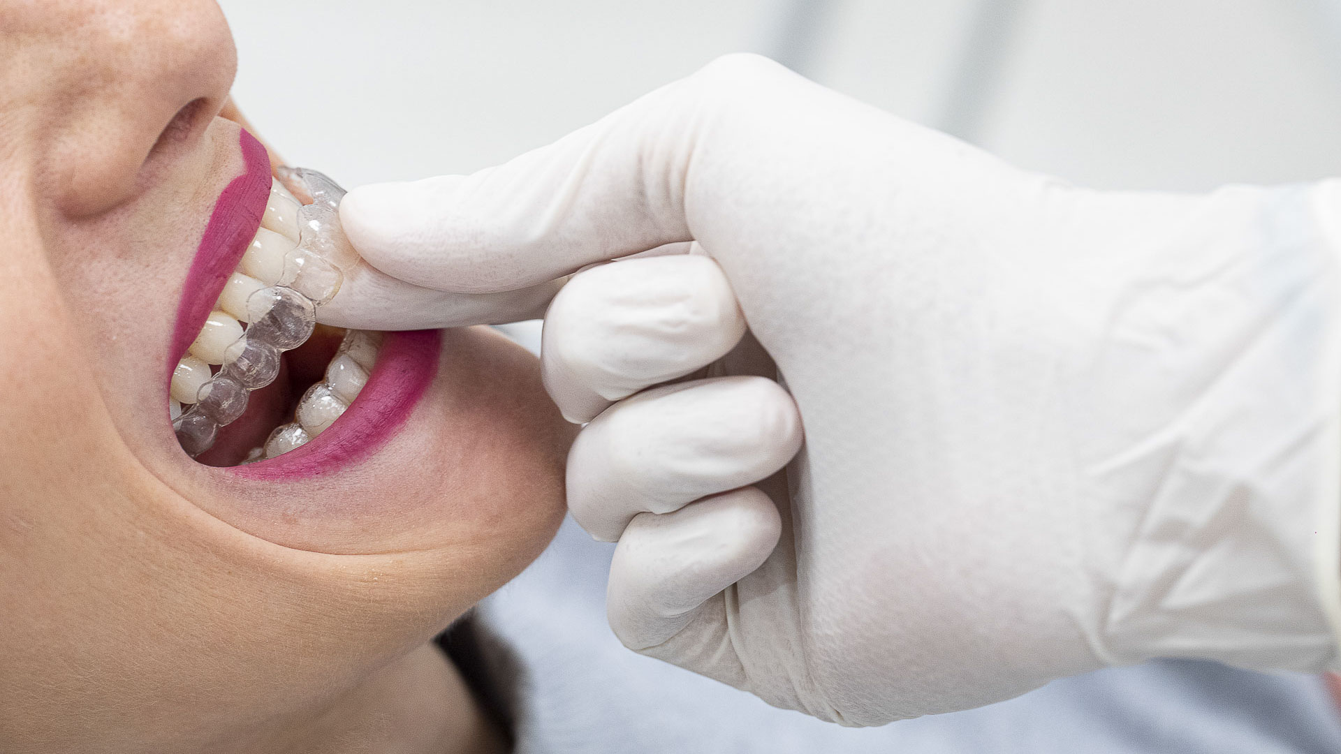 295A1919invisalign-quarta-odontoiatria-studio-dentistico-carmiano-lecce