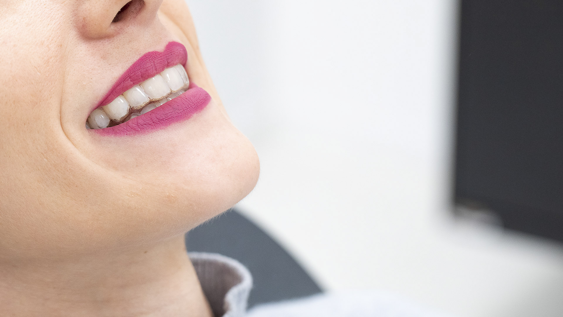 295A1965invisalign-quarta-odontoiatria-studio-dentistico-carmiano-lecce